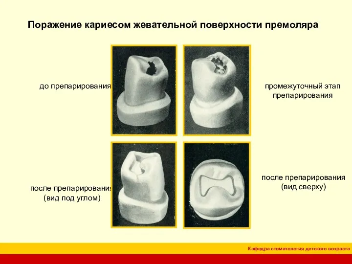 Поражение кариесом жевательной поверхности премоляра до препарирования промежуточный этап препарирования