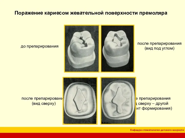 Поражение кариесом жевательной поверхности премоляра до препарирования после препарирования (вид