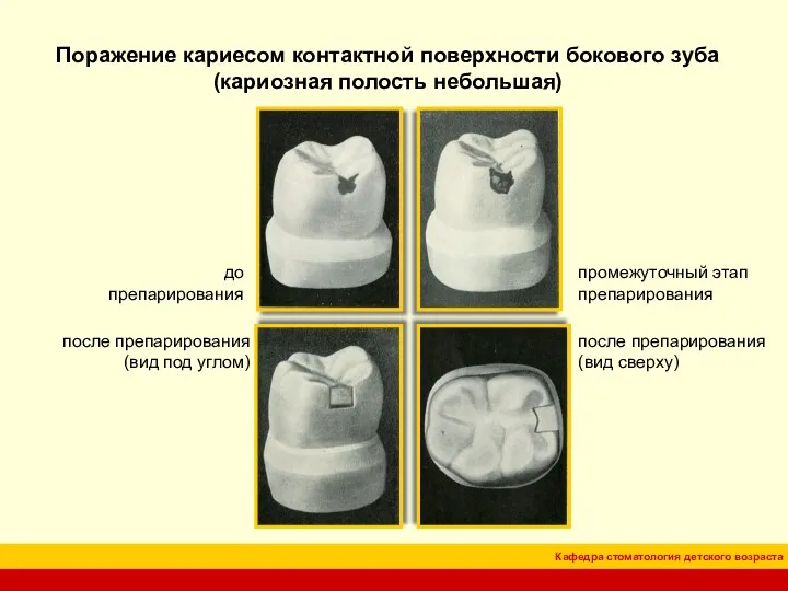 Поражение кариесом контактной поверхности бокового зуба (кариозная полость небольшая) до