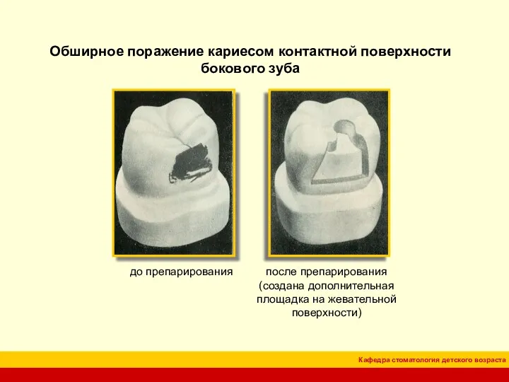 Обширное поражение кариесом контактной поверхности бокового зуба до препарирования после препарирования (создана дополнительная