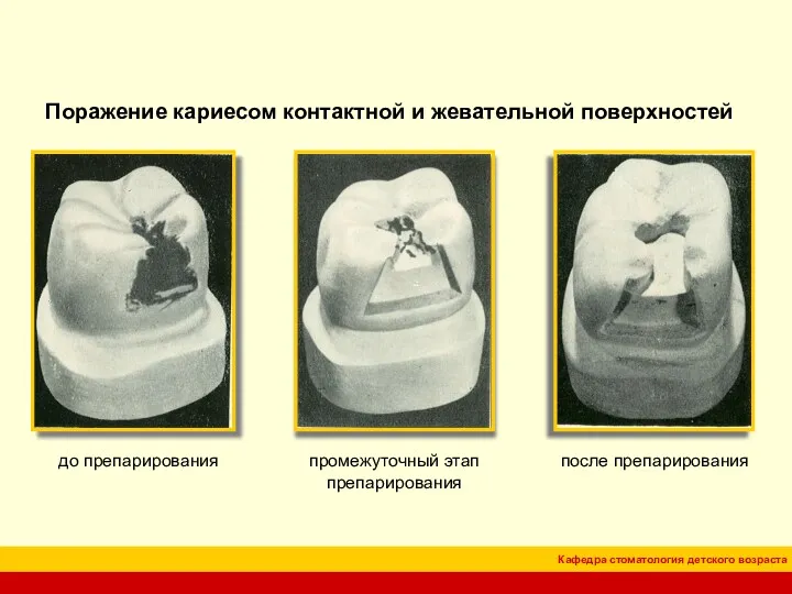 Поражение кариесом контактной и жевательной поверхностей до препарирования промежуточный этап препарирования после препарирования