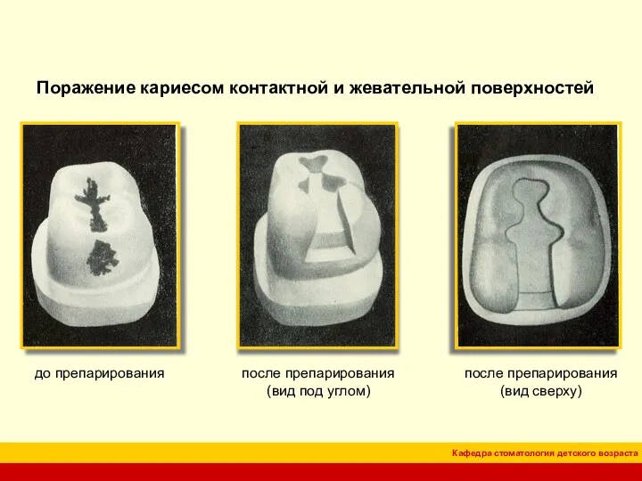 Поражение кариесом контактной и жевательной поверхностей до препарирования после препарирования