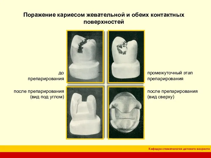 Поражение кариесом жевательной и обеих контактных поверхностей до препарирования промежуточный