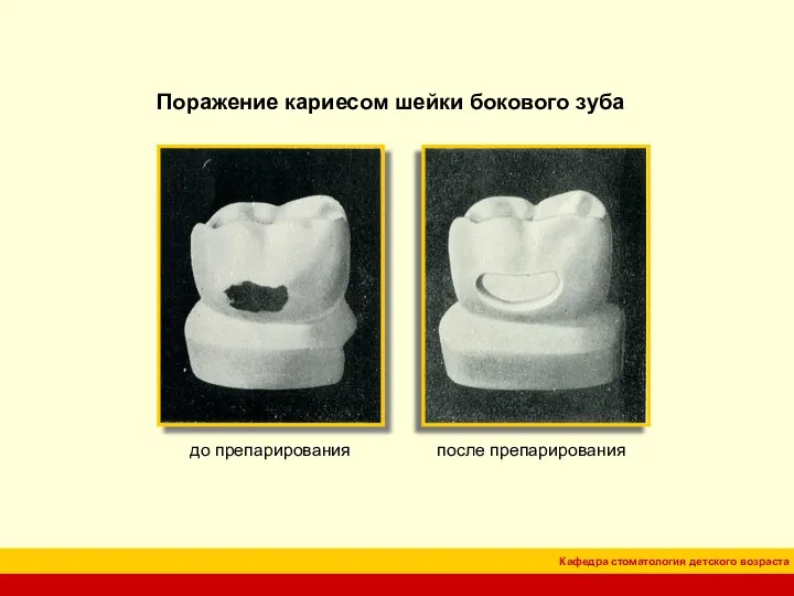 Поражение кариесом шейки бокового зуба до препарирования после препарирования