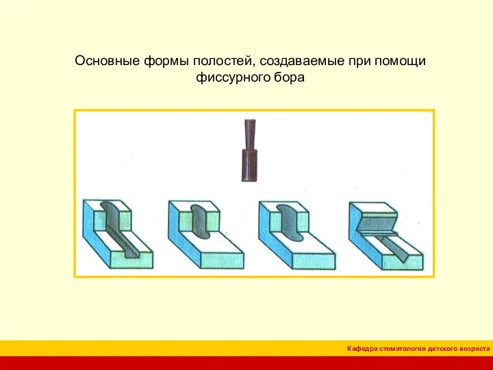 Основные формы полостей, создаваемые при помощи фиссурного бора