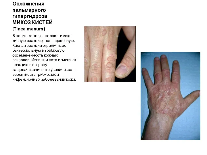 Осложнения пальмарного гипергидроза МИКОЗ КИСТЕЙ (Tinea manum) В норме кожные покровы имеют кислую