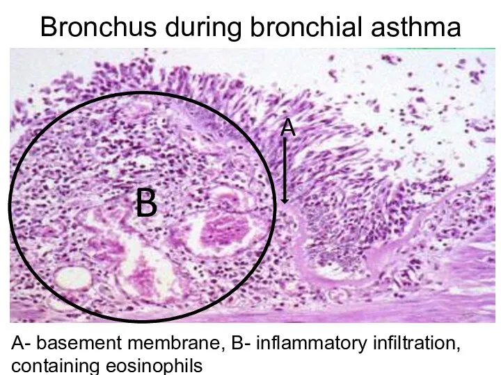 Bronchus during bronchial asthma A- basement membrane, B- inflammatory infiltration, containing eosinophils A B