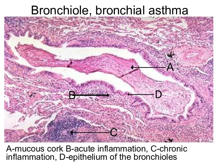 Bronchiole, bronchial asthma А-mucous cork В-acute inflammation, C-chronic inflammation, D-epithelium