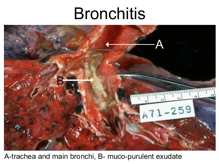 Bronchitis А-trachea and main bronchi, В- muco-purulent exudate А В