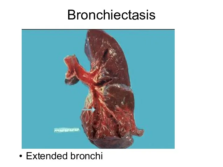 Bronchiectasis Extended bronchi