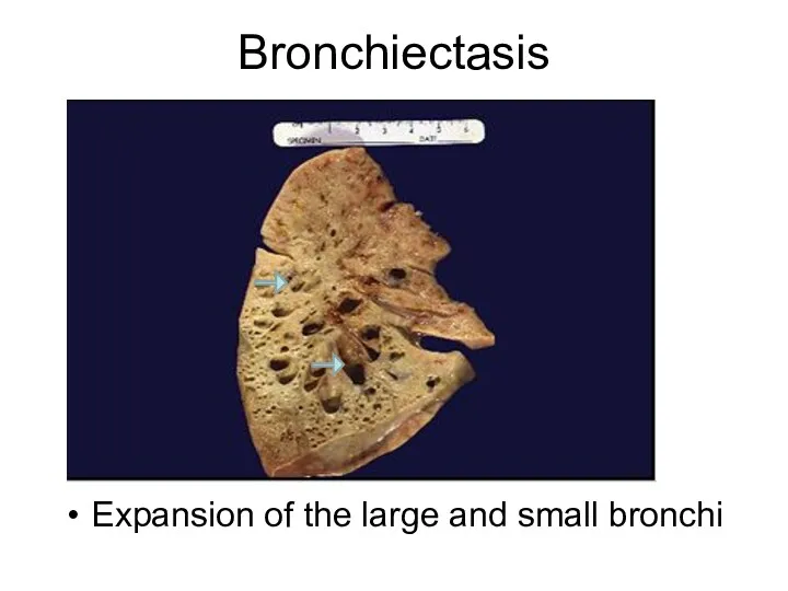 Bronchiectasis Expansion of the large and small bronchi