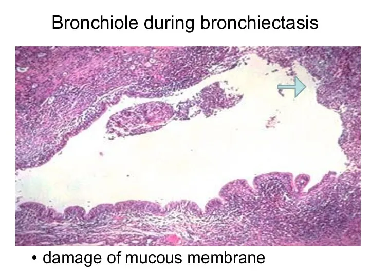 Bronchiole during bronchiectasis damage of mucous membrane