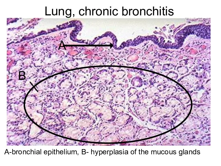 Lung, chronic bronchitis А-bronchial epithelium, В- hyperplasia of the mucous glands А В
