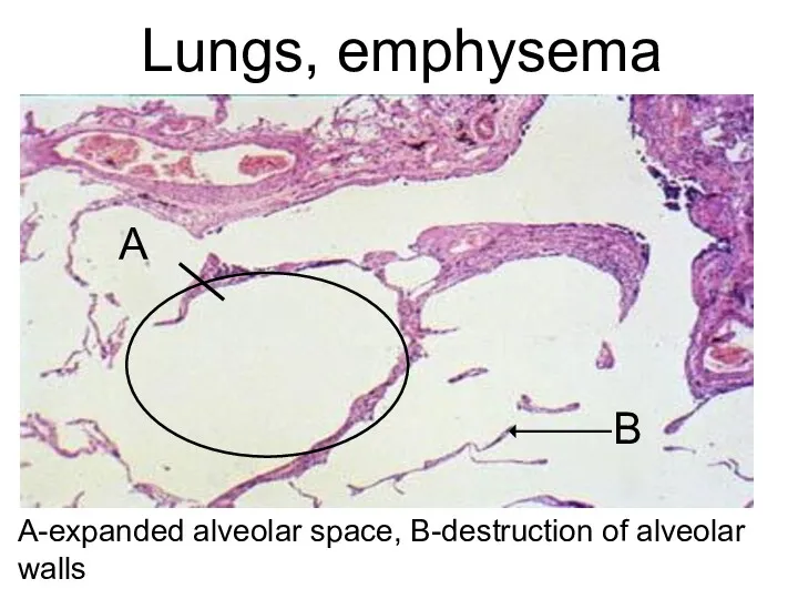 Lungs, emphysema А-expanded alveolar space, В-destruction of alveolar walls А В