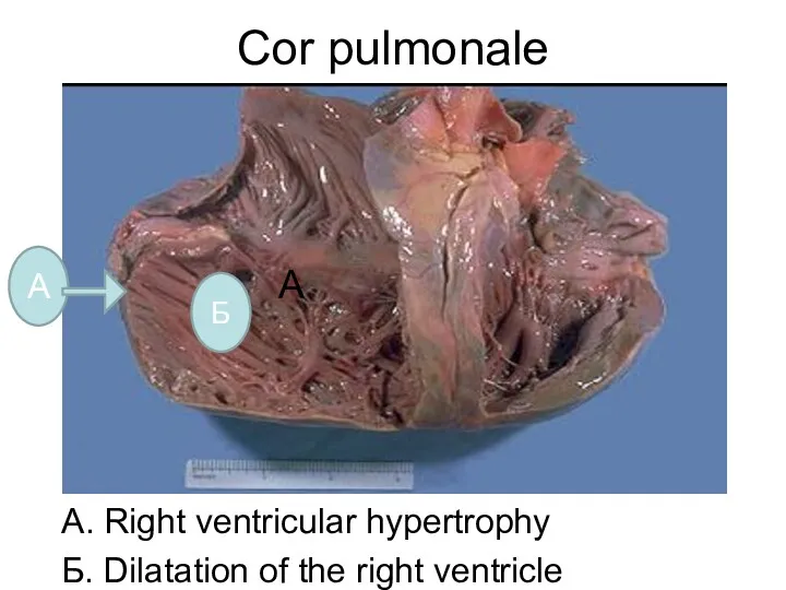 Cor pulmonale А. Right ventricular hypertrophy Б. Dilatation of the right ventricle А Б А