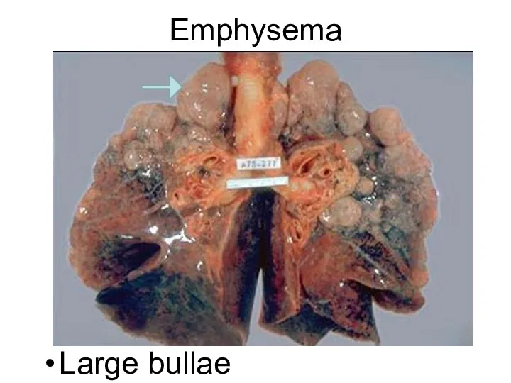 Emphysema Large bullae