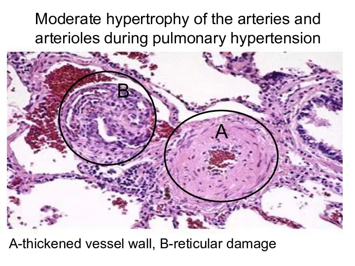 Moderate hypertrophy of the arteries and arterioles during pulmonary hypertension