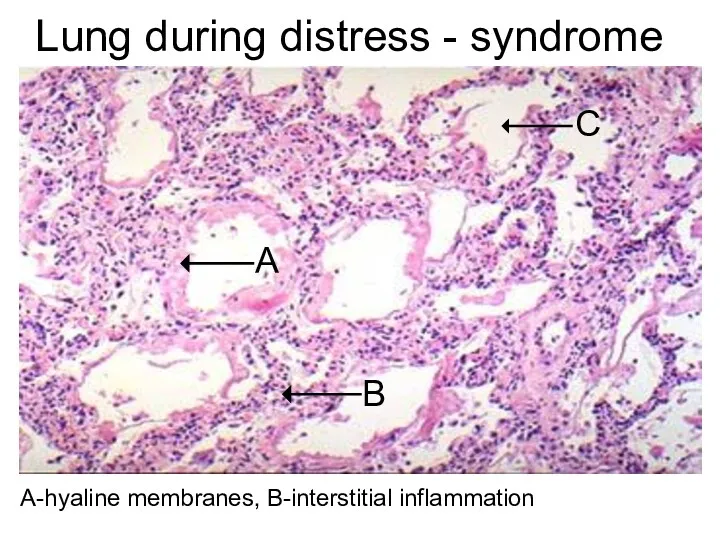 Lung during distress - syndrome А-hyaline membranes, В-interstitial inflammation В А С