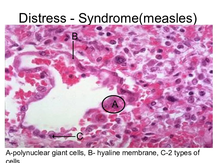 Distress - Syndrome(measles) А-polynuclear giant cells, В- hyaline membrane, С-2 types of cells. А В С