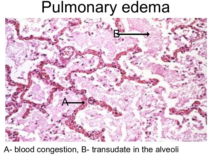 Pulmonary edema А- blood congestion, В- transudate in the alveoli А В