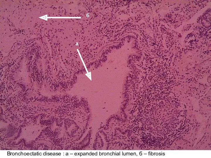 Bronchoectatic disease : а – expanded bronchial lumen, б – fibrosis а б