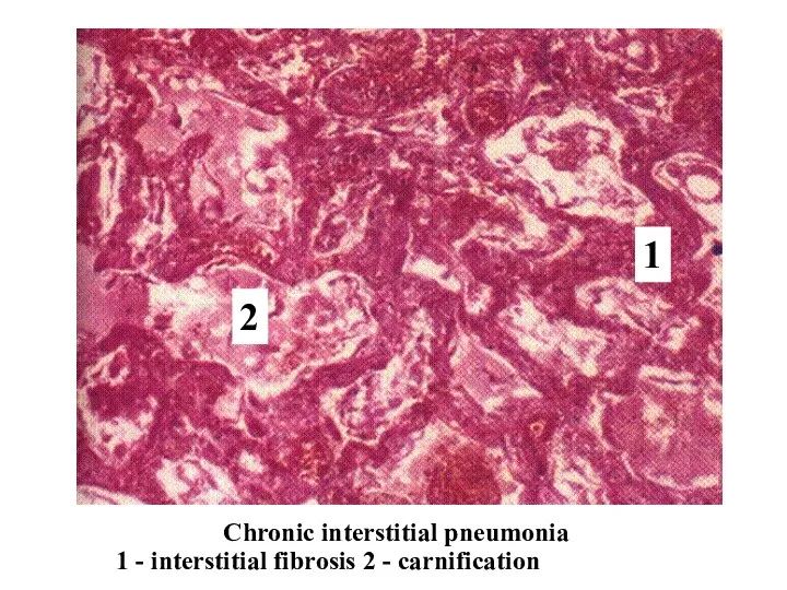 Chronic interstitial pneumonia 1 2 1 - interstitial fibrosis 2 - carnification