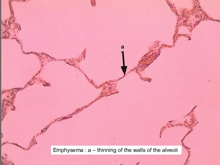 Emphysema : а – thinning of the walls of the alveoli а