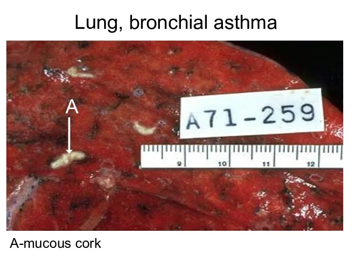 Lung, bronchial asthma А-mucous cork А