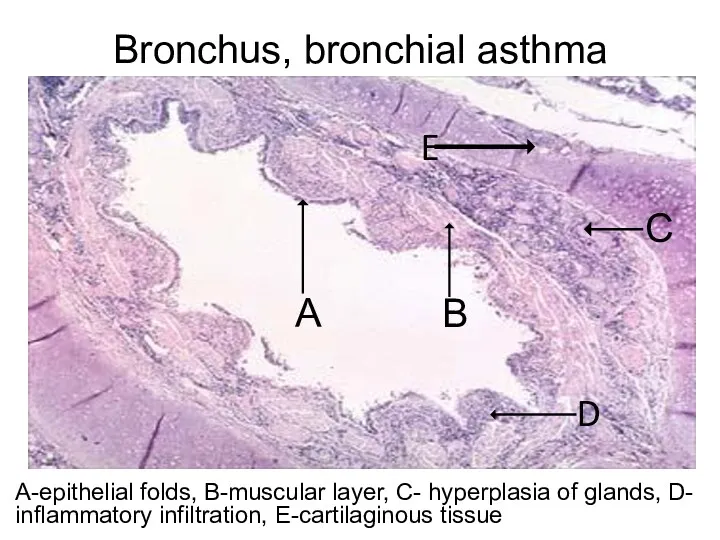 Bronchus, bronchial asthma А-epithelial folds, В-muscular layer, C- hyperplasia of