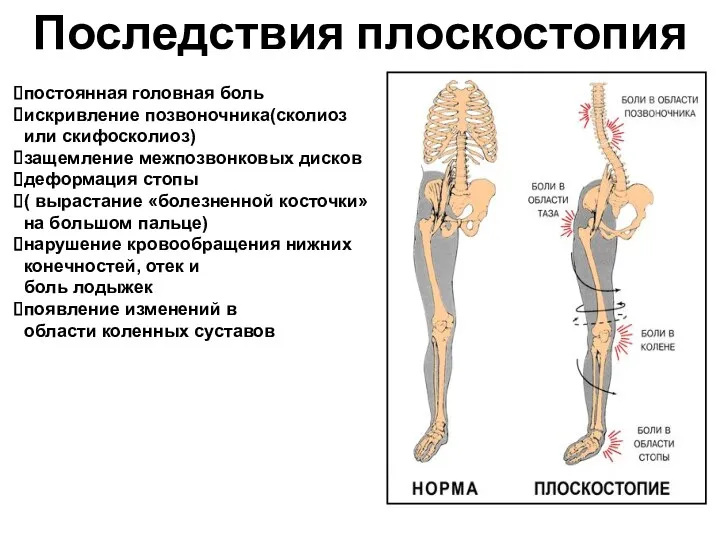 постоянная головная боль искривление позвоночника(сколиоз или скифосколиоз) защемление межпозвонковых дисков