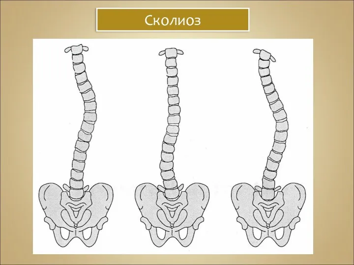 Сколиоз