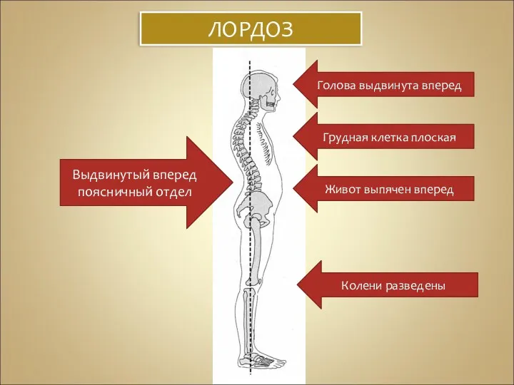 ЛОРДОЗ Голова выдвинута вперед Грудная клетка плоская Живот выпячен вперед Колени разведены Выдвинутый вперед поясничный отдел