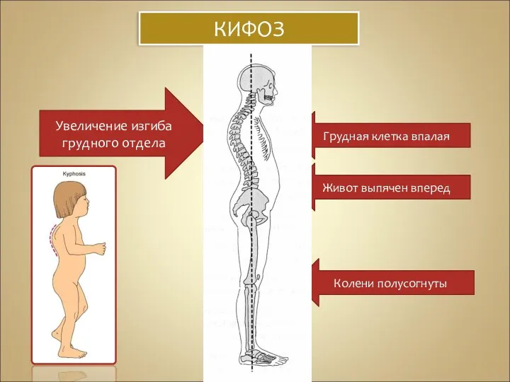 КИФОЗ Грудная клетка впалая Живот выпячен вперед Колени полусогнуты Увеличение изгиба грудного отдела