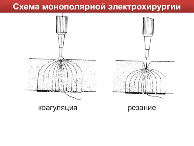 Схема монополярной электрохирургии коагуляция резание