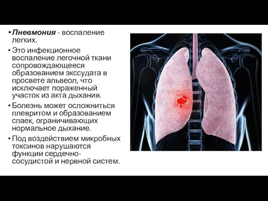Пневмония - воспаление легких. Это инфекционное воспаление легочной ткани сопровождающееся