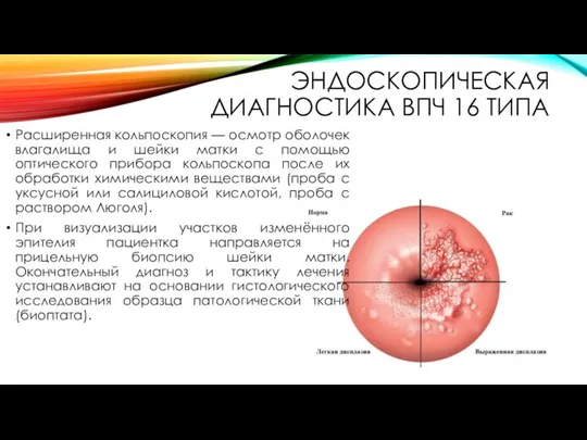 ЭНДОСКОПИЧЕСКАЯ ДИАГНОСТИКА ВПЧ 16 ТИПА Расширенная кольпоскопия — осмотр оболочек