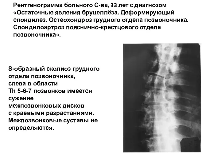 Рентгенограмма больного С-ва, 33 лет с диагнозом «Остаточные явления бруцеллёза.