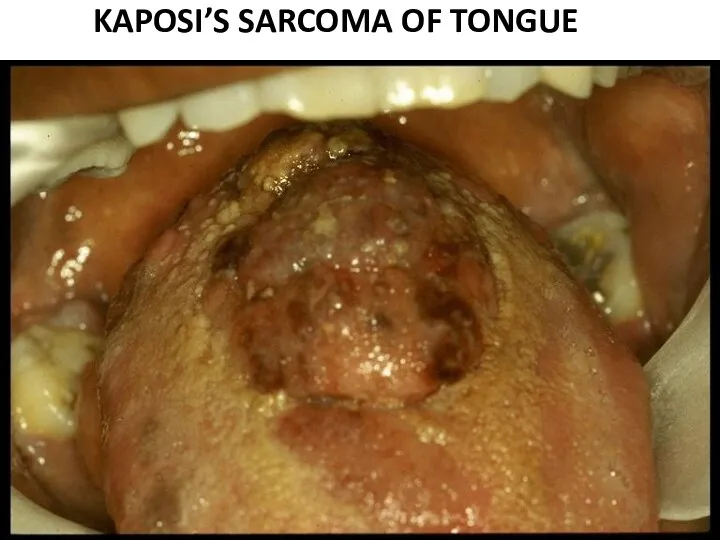 KAPOSI’S SARCOMA OF TONGUE