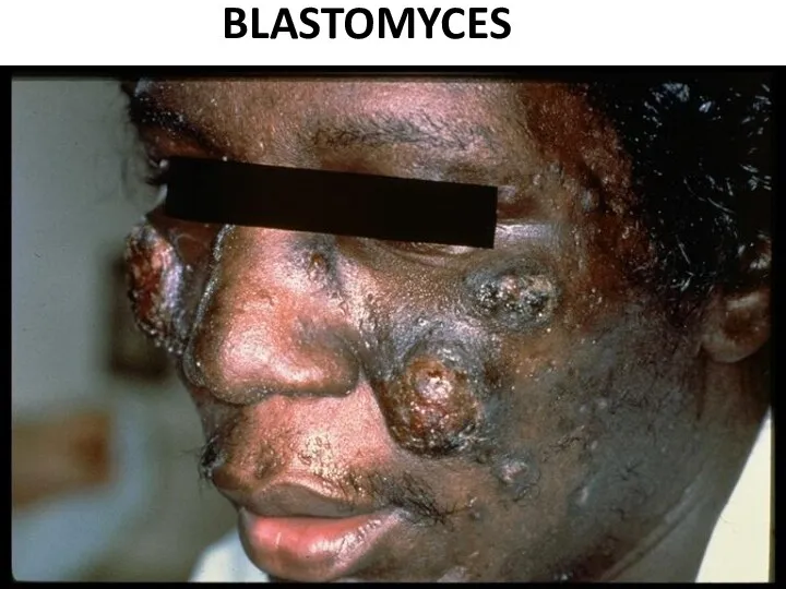 BLASTOMYCES