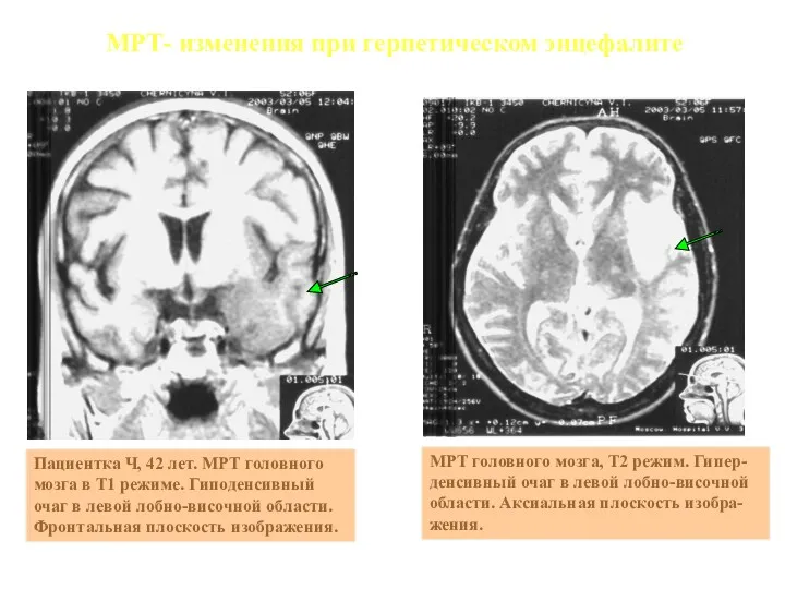 Пациентка Ч, 42 лет. МРТ головного мозга в Т1 режиме.