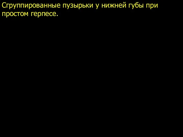 Сгруппированные пузырьки у нижней губы при простом герпесе.