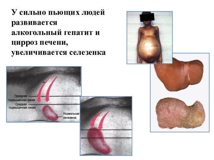 У сильно пьющих людей развивается алкогольный гепатит и цирроз печени, увеличивается селезенка