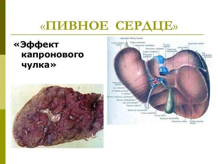 «ПИВНОЕ СЕРДЦЕ» «Эффект капронового чулка»