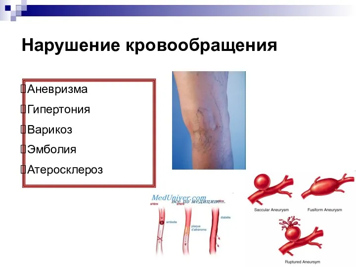 Нарушение кровообращения Аневризма Гипертония Варикоз Эмболия Атеросклероз