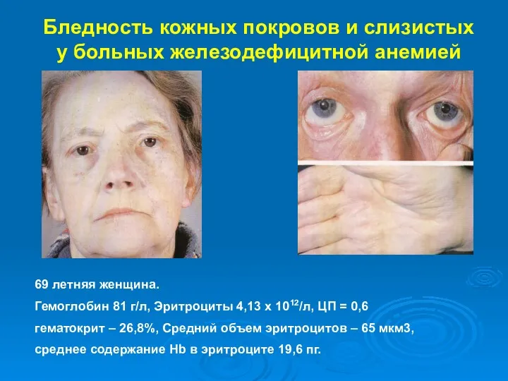 Бледность кожных покровов и слизистых у больных железодефицитной анемией 69