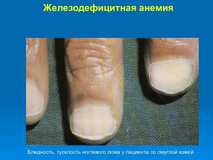Железодефицитная анемия Бледность, тусклость ногтевого ложа у пациента со смуглой кожей