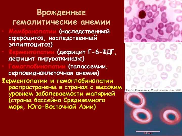 Врожденные гемолитические анемии Мембранопатии (наследственный сфероцитоз, наследственный эллиптоцитоз) Ферментопатии (дефицит Г-6-ФДГ, дефицит пируваткиназы)