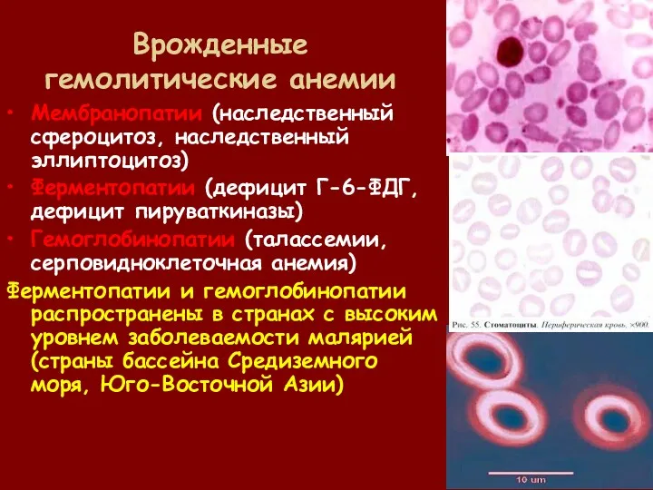 Врожденные гемолитические анемии Мембранопатии (наследственный сфероцитоз, наследственный эллиптоцитоз) Ферментопатии (дефицит