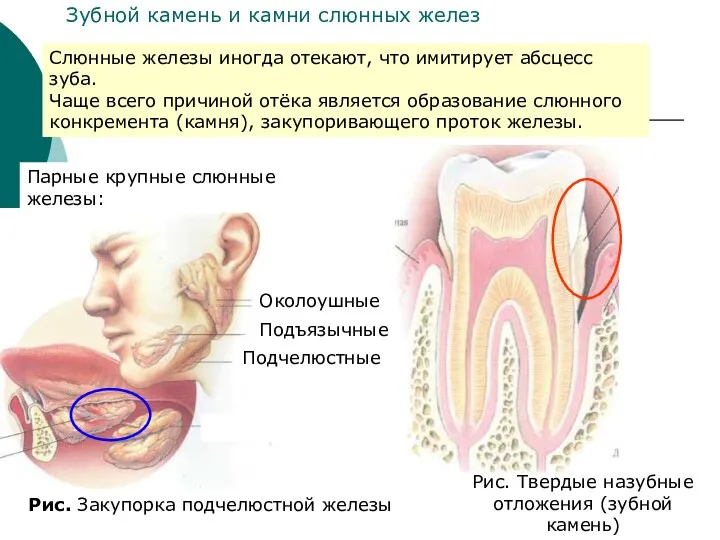 Парные крупные слюнные железы: Околоушные Подъязычные Подчелюстные Рис. Закупорка подчелюстной