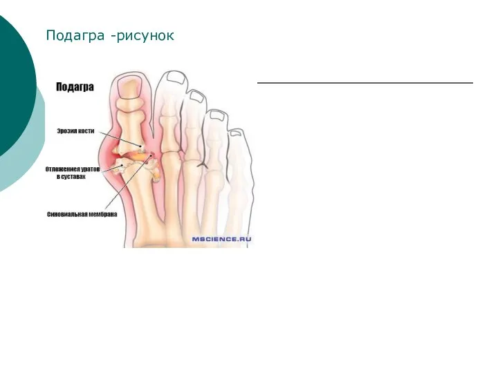 Подагра -рисунок